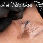 fibroblast gloved hand near eye