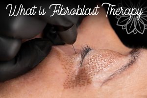 Fibroblast Therapy? What is that?!?!?
